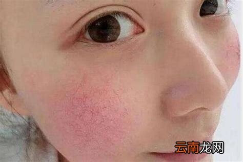 染料激光去红血丝价格揭秘，重塑自信的力量之源